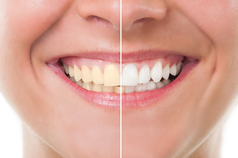 Teeth Whitening - Healthy Smiles by Joyce, Irvine Dentist