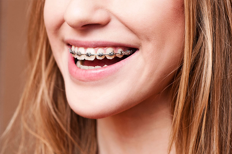 Orthodontics - Healthy Smiles by Joyce, Irvine Dentist